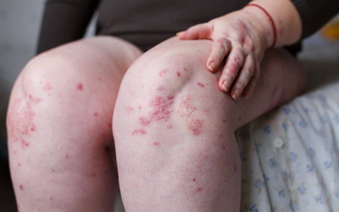 5 Alternative Treatments and Home Remedies for Psoriasis